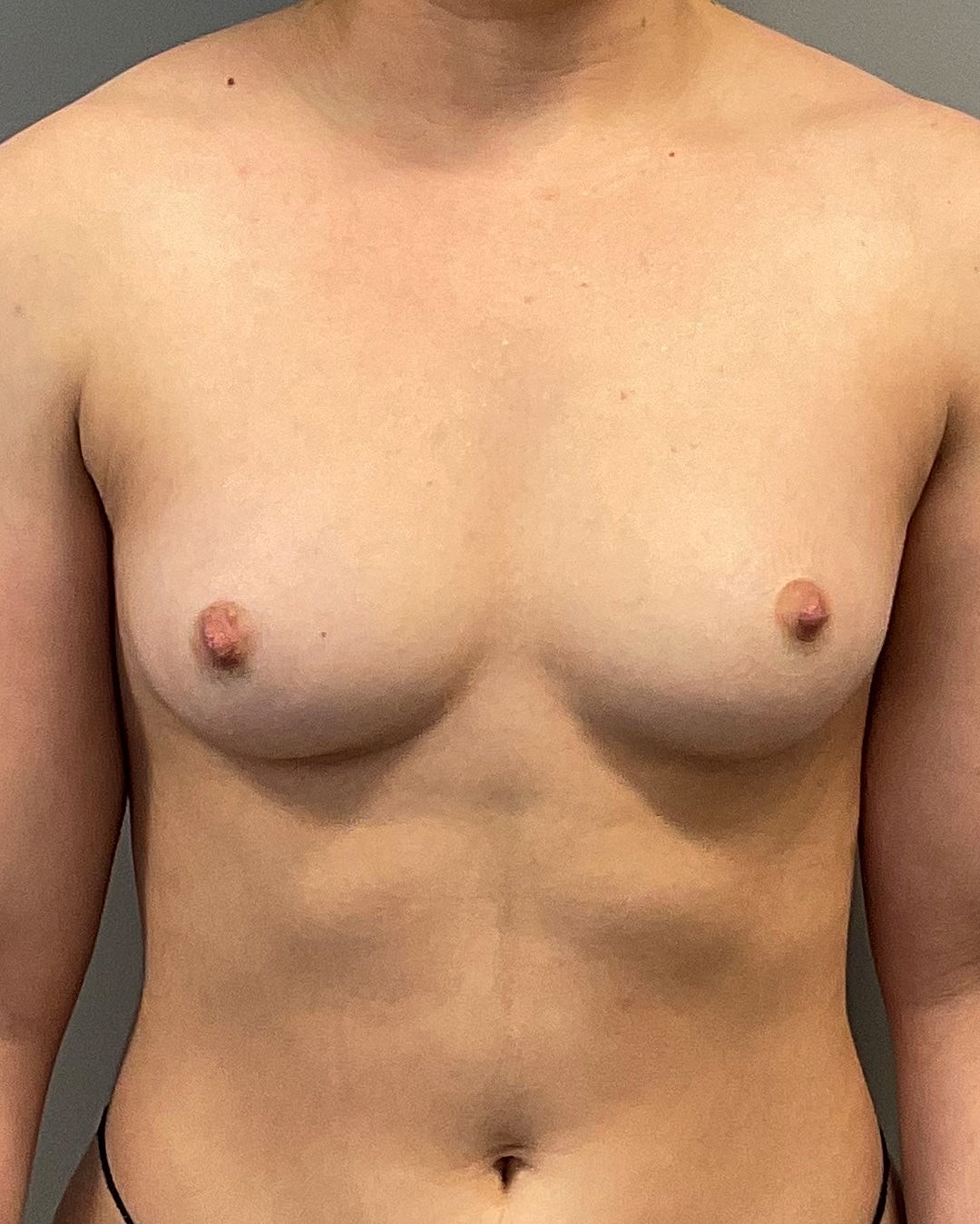 Breast Augmentation Before & After