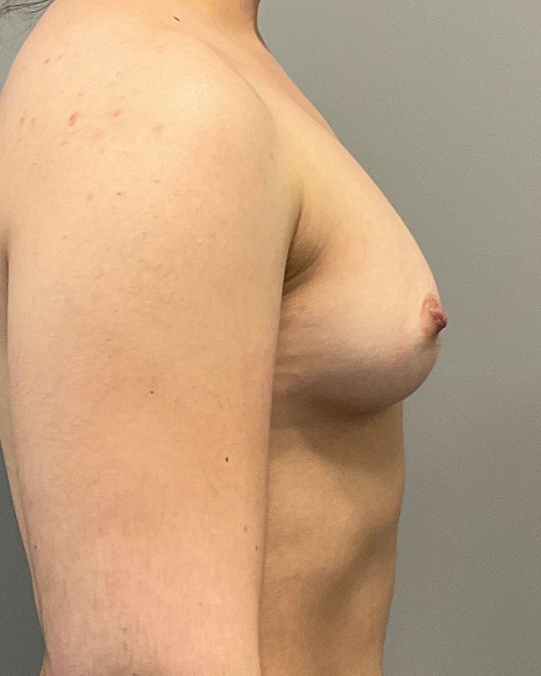 Breast Augmentation Before & After