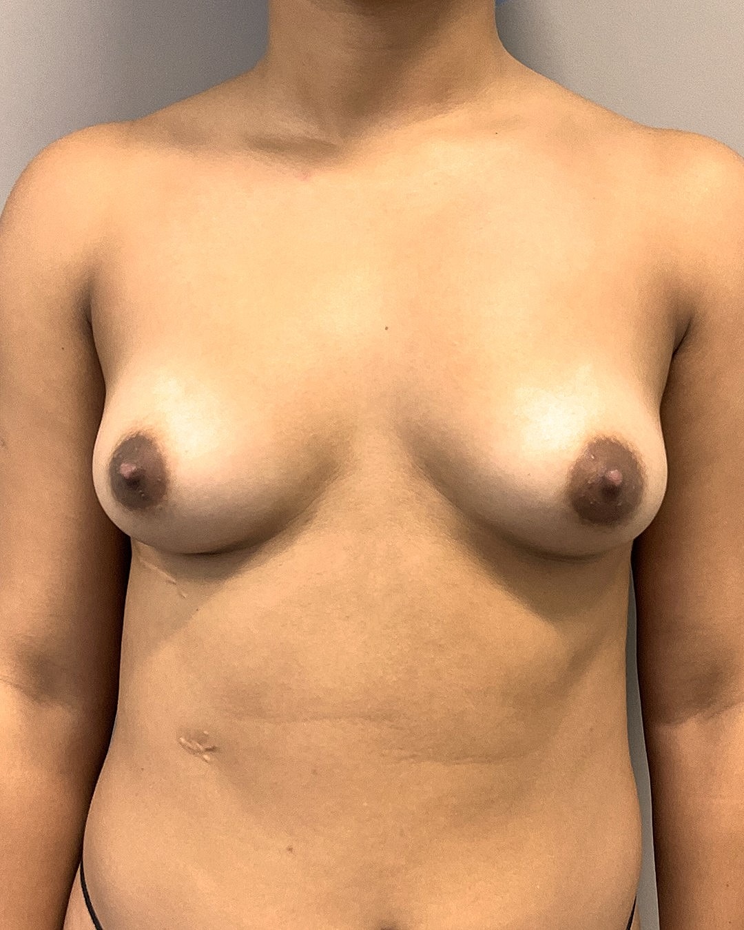Breast Augmentation Before & After