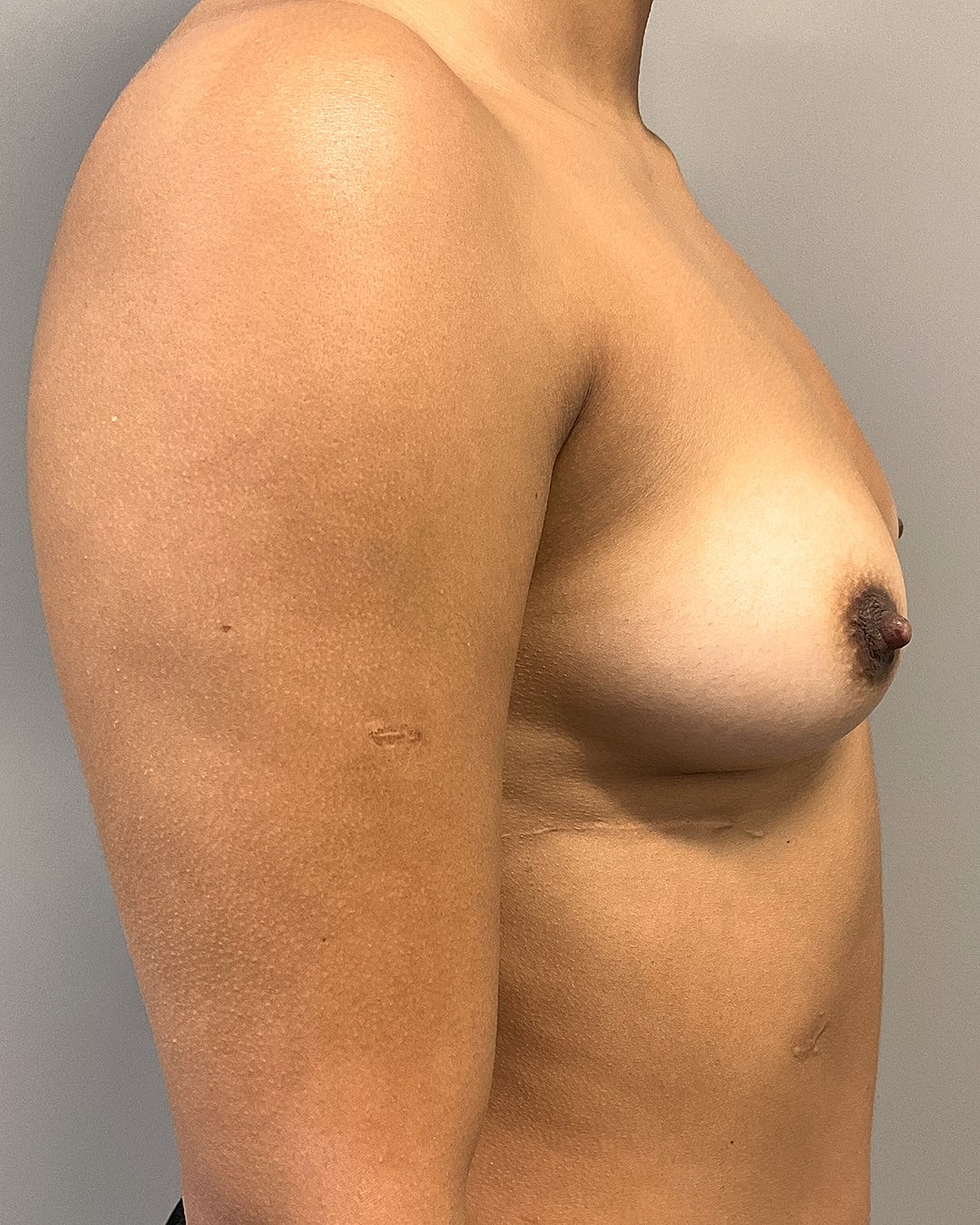 Breast Augmentation Before & After