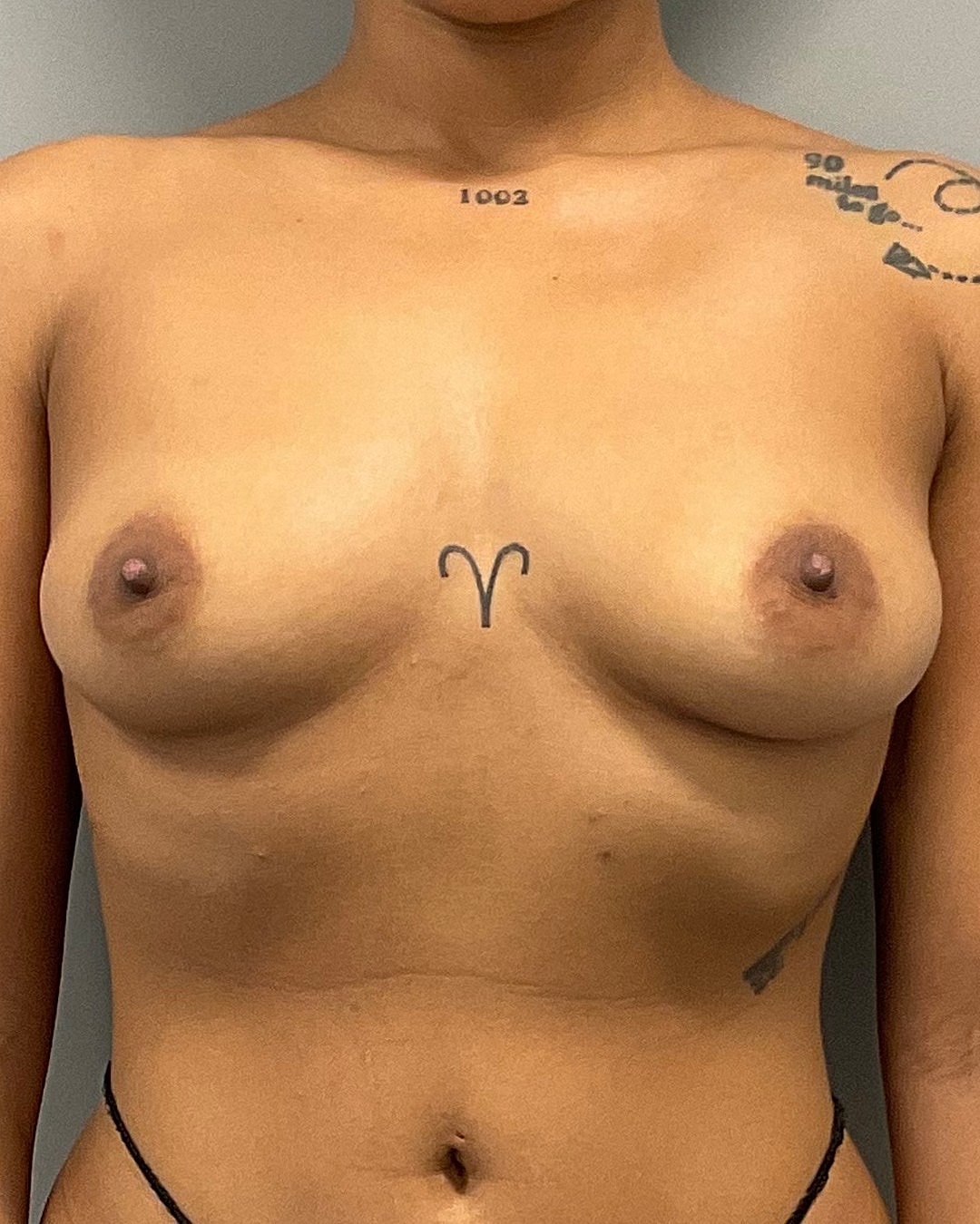 Breast Augmentation Before & After