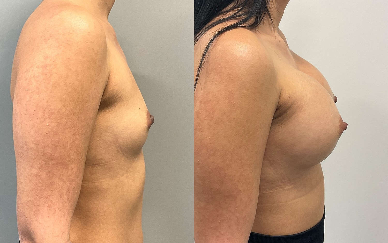Breast Augmentation Before & After