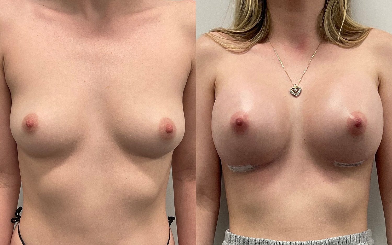Breast Augmentation Before & After