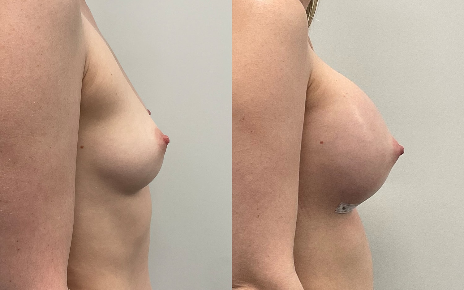 Breast Augmentation Before & After