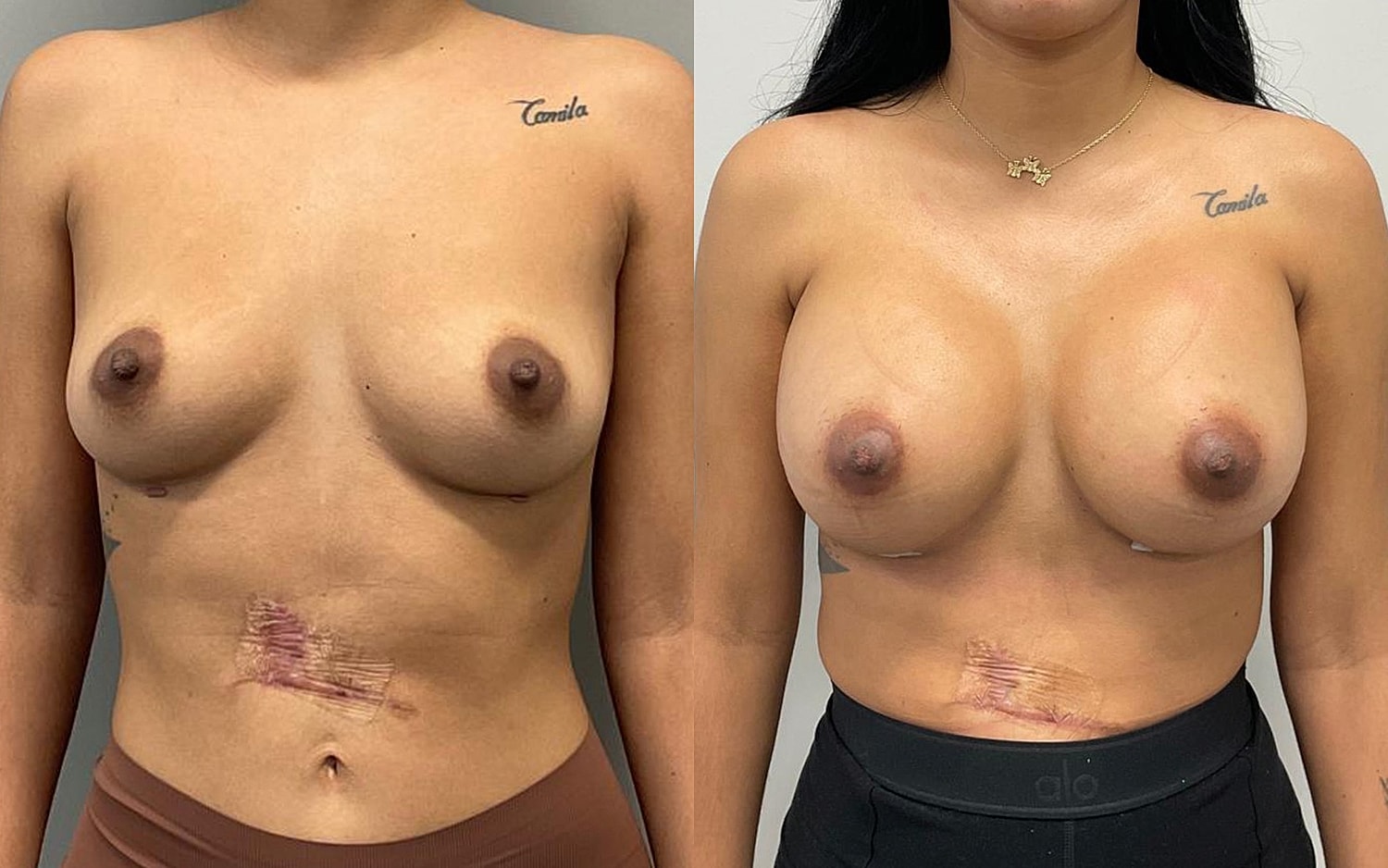 Breast Augmentation Before & After