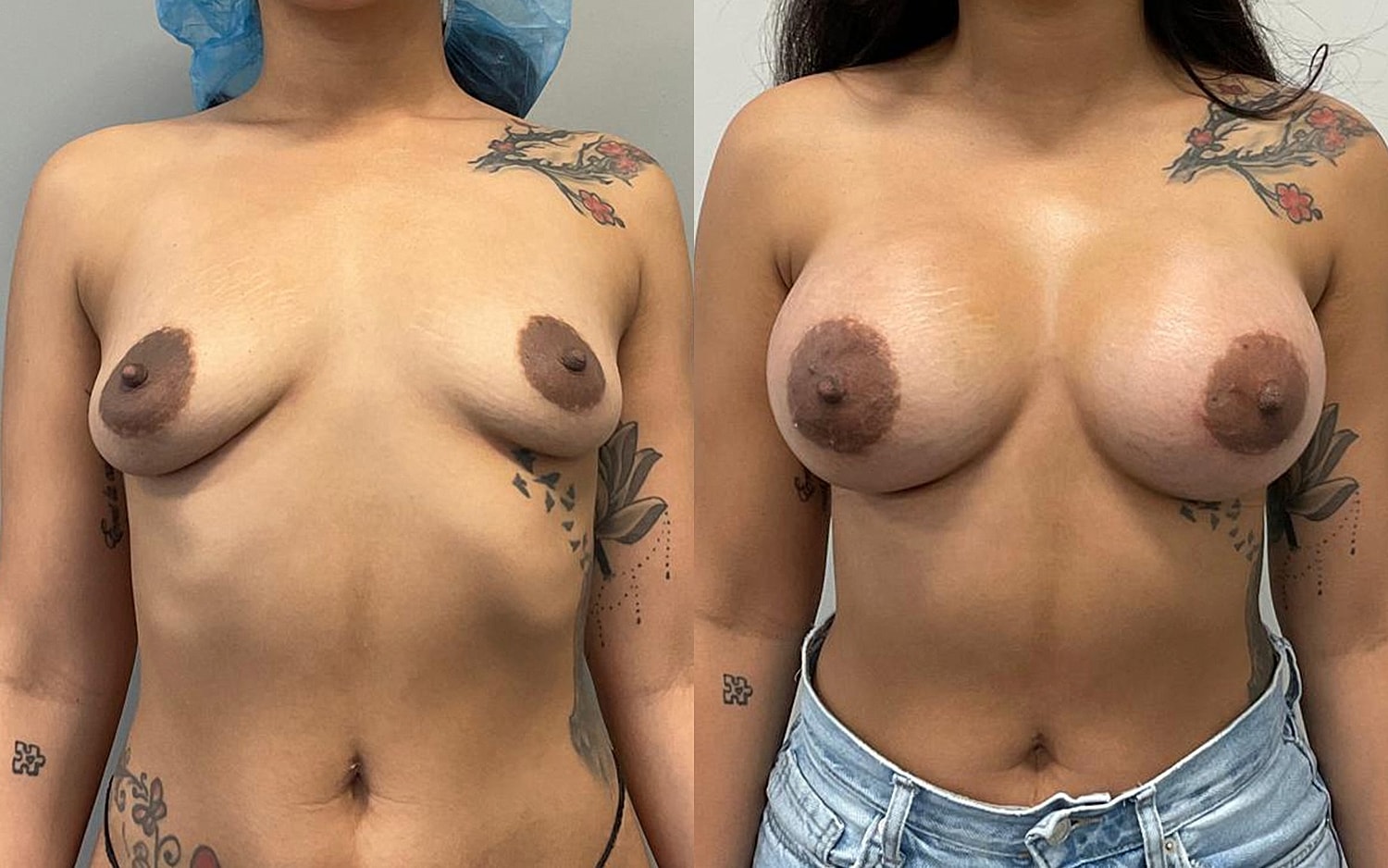 Breast Augmentation Before & After