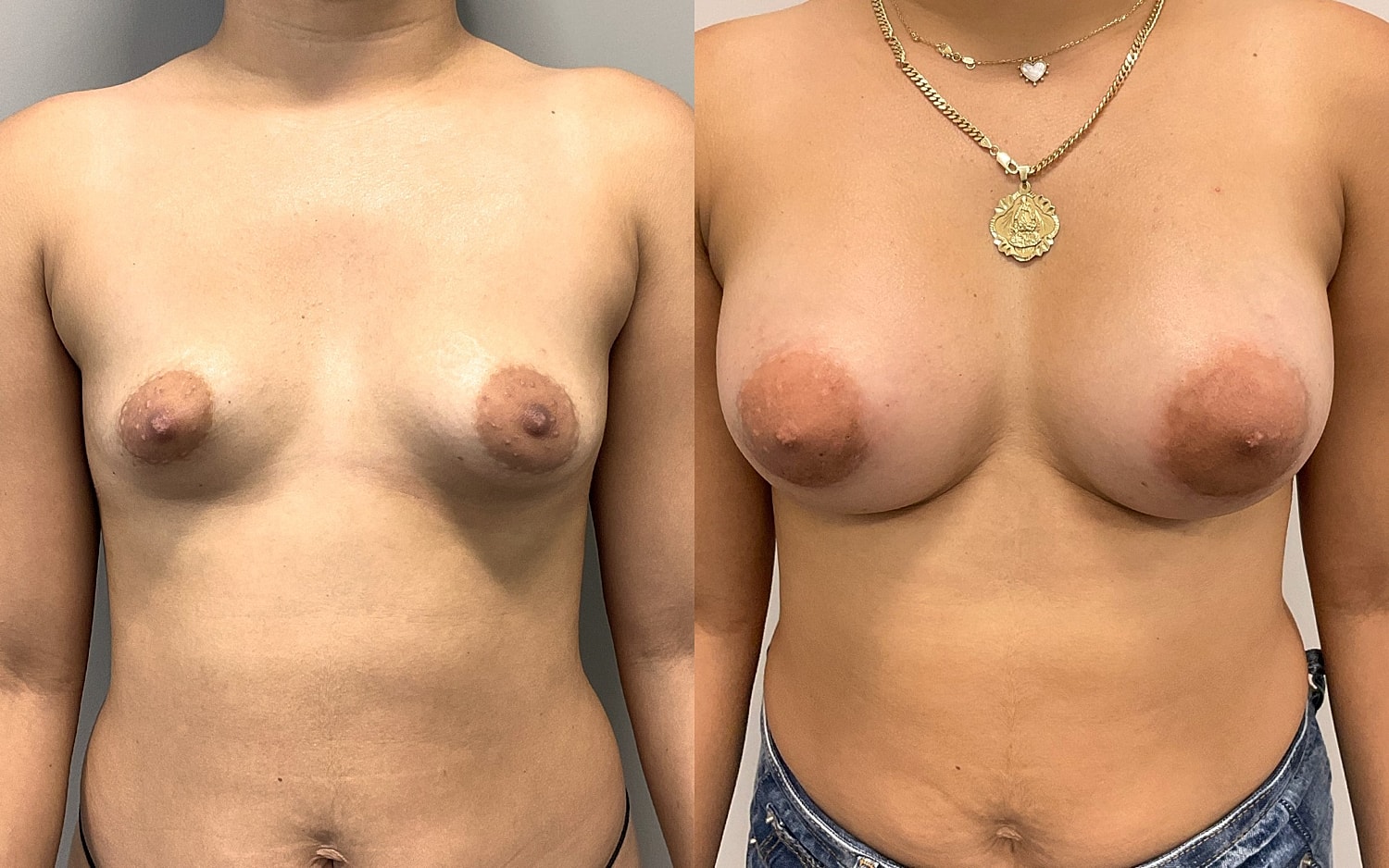 Breast Augmentation Before & After