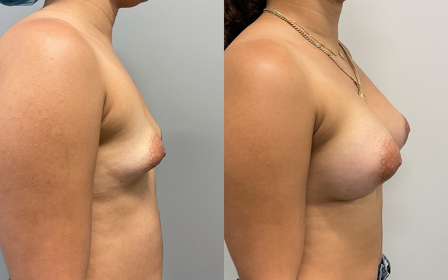Breast Augmentation Before & After
