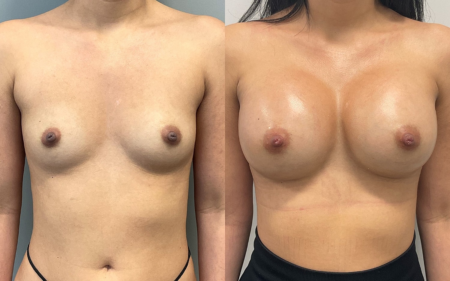 Breast Augmentation Before & After