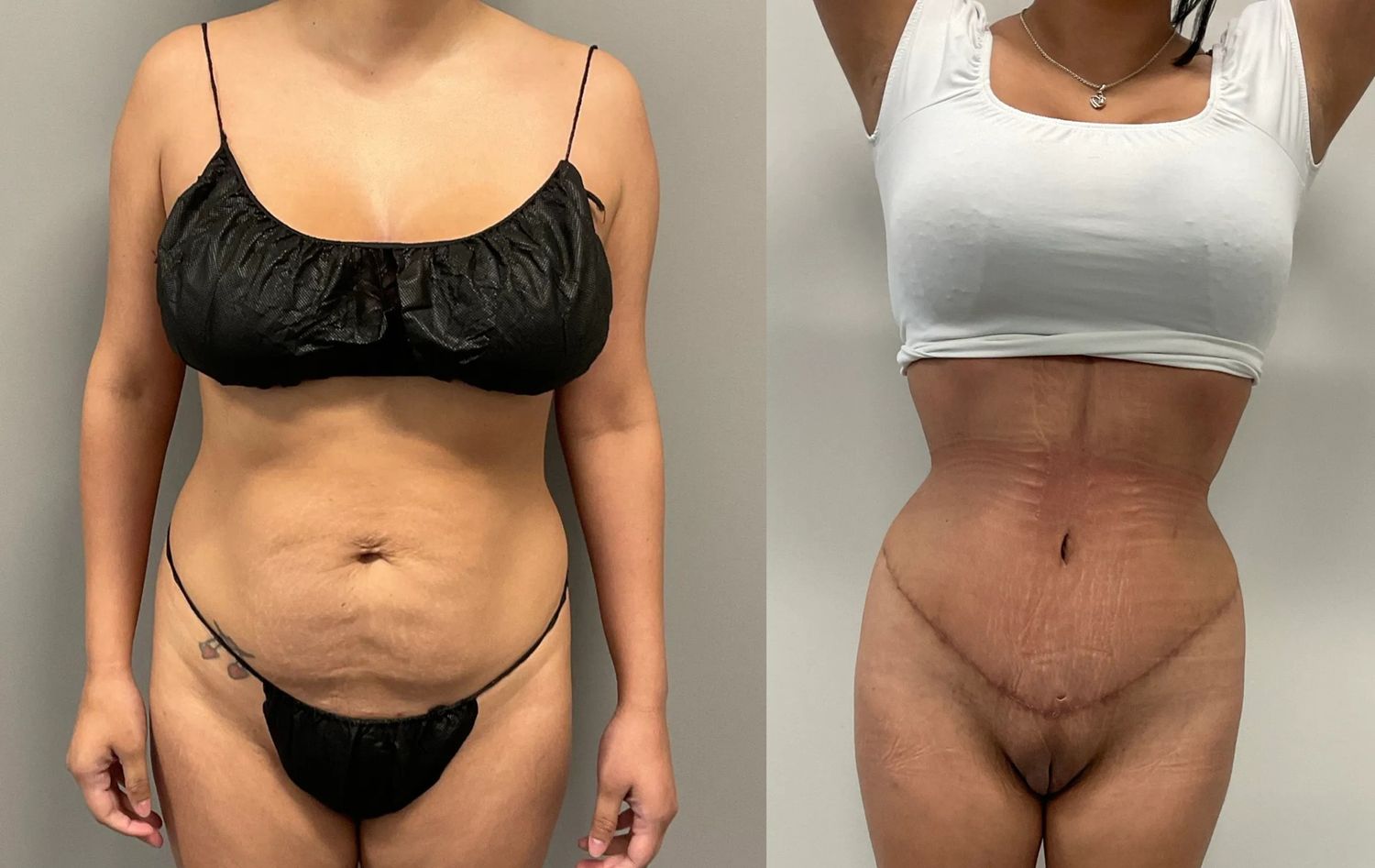 Abdominoplasty Before & After