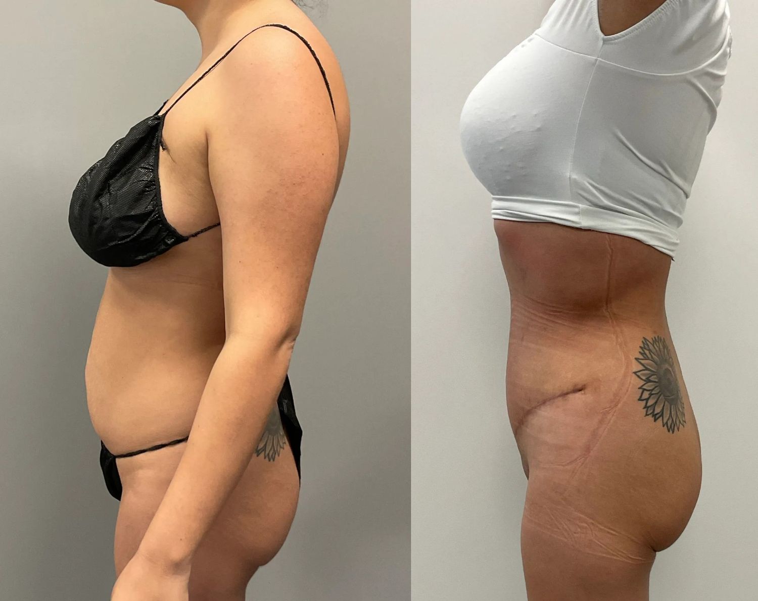Abdominoplasty Before & After
