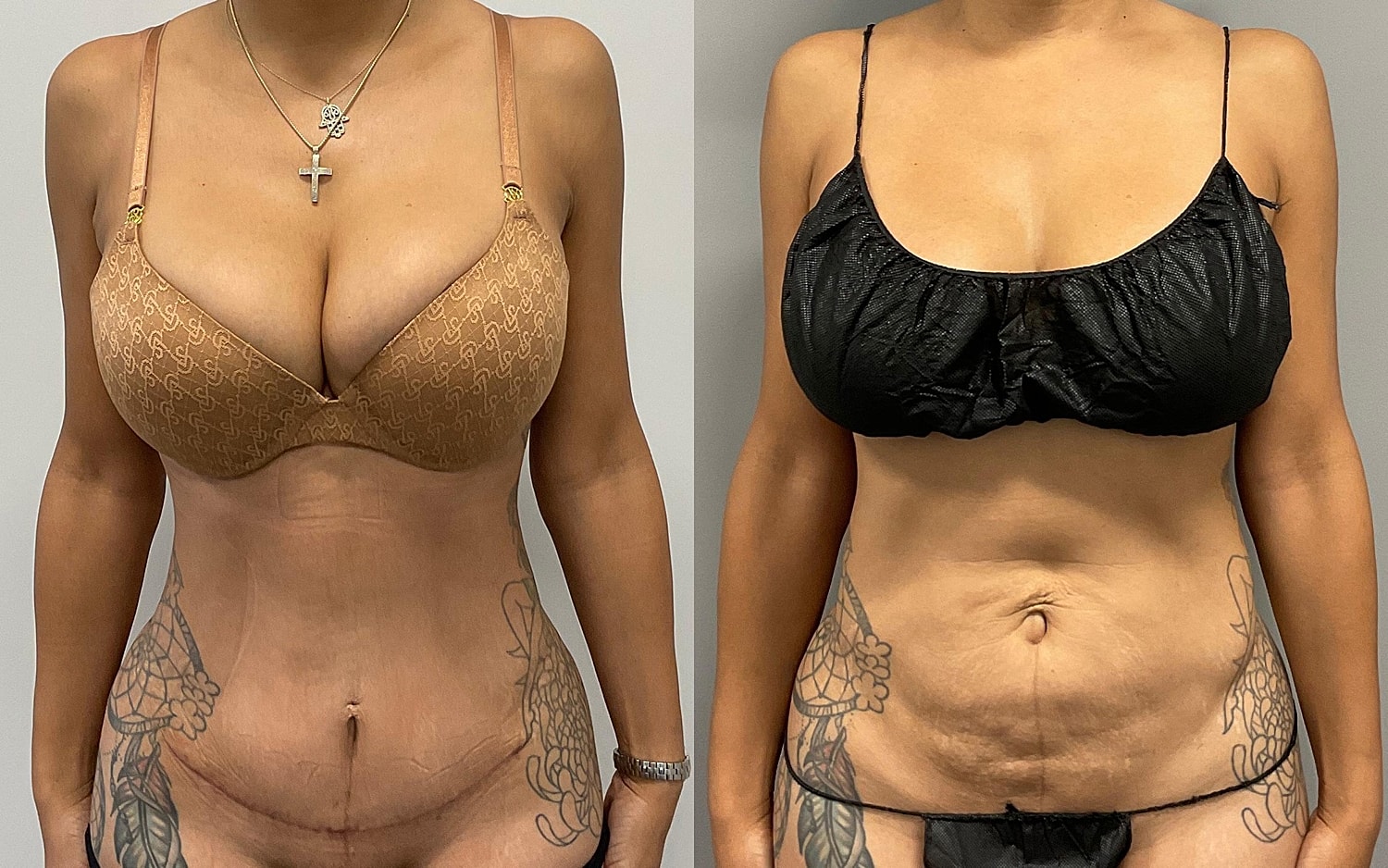 Tummy Tuck Before & After