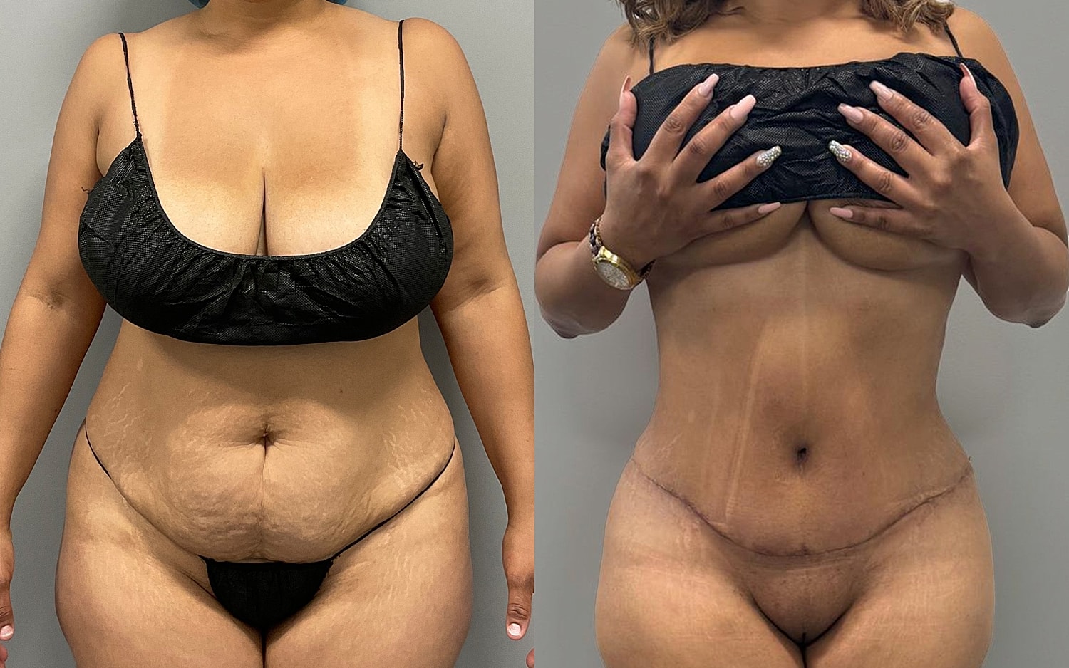 Tummy Tuck Before & After