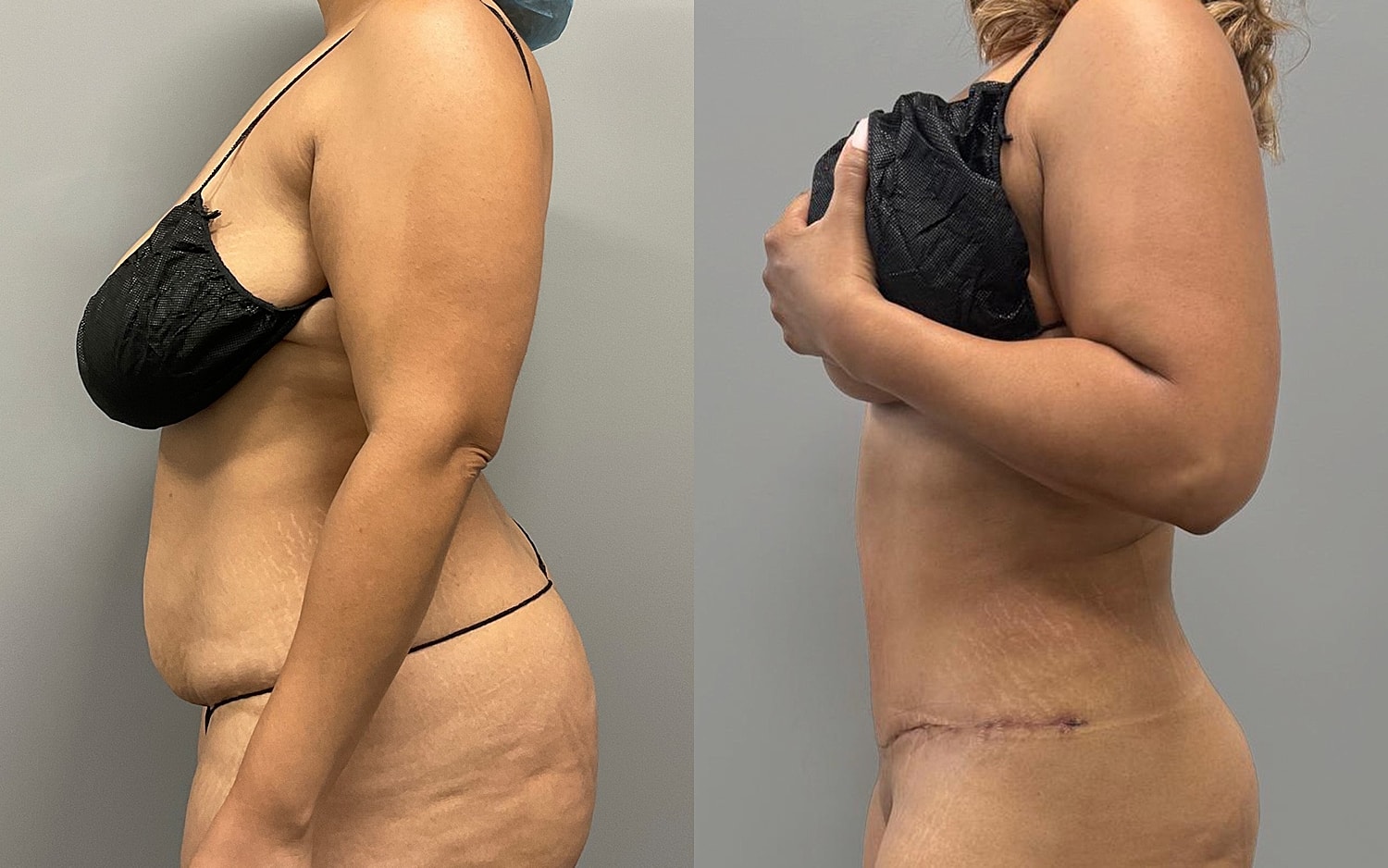Tummy Tuck Before & After