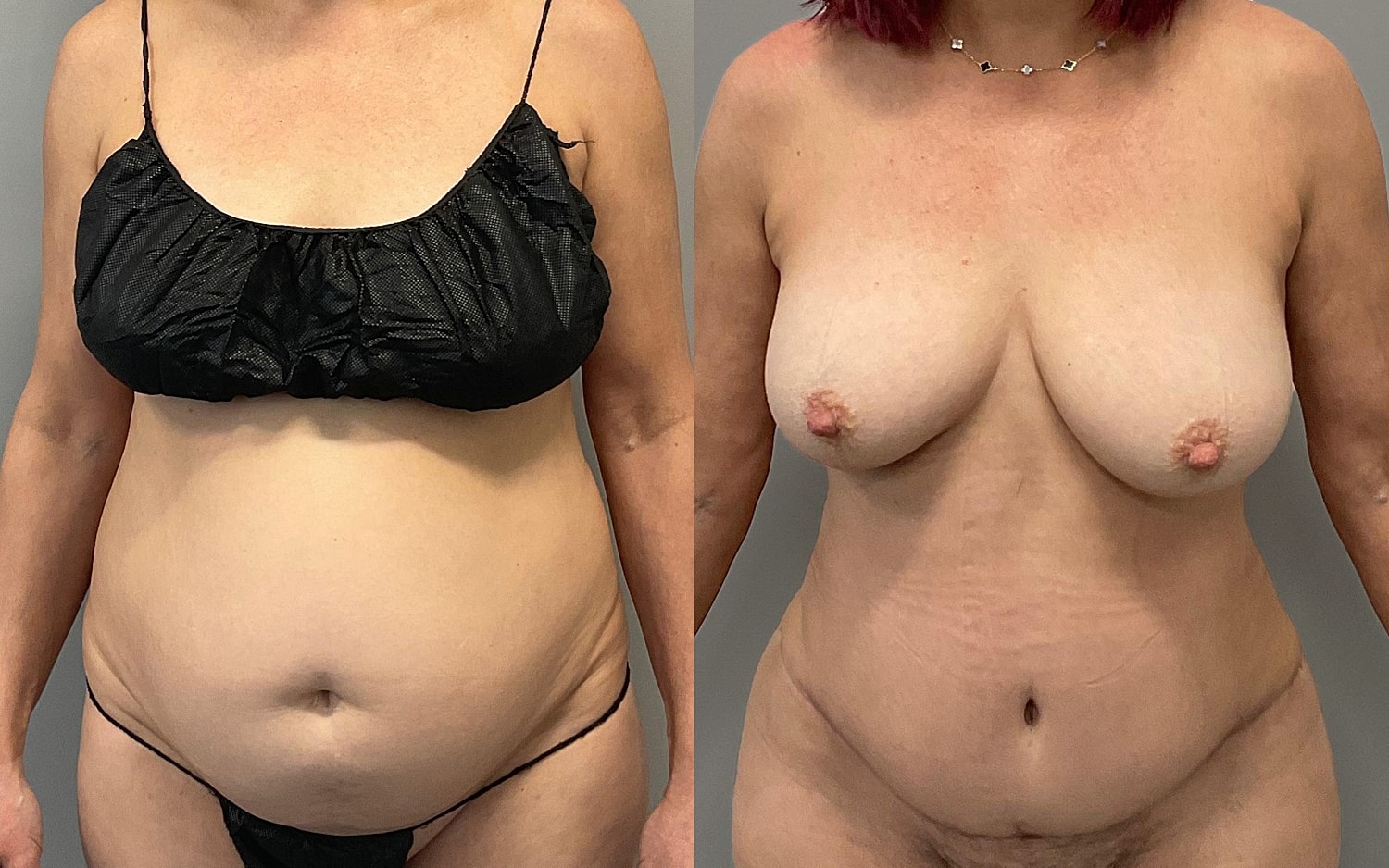 Tummy Tuck Before & After