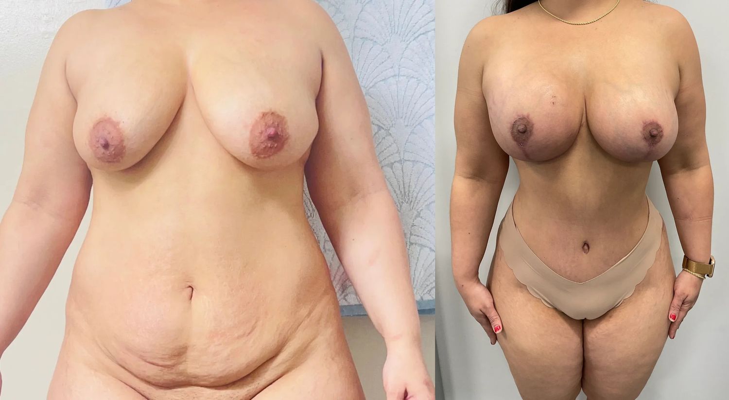 Mommy Makeover Before & After