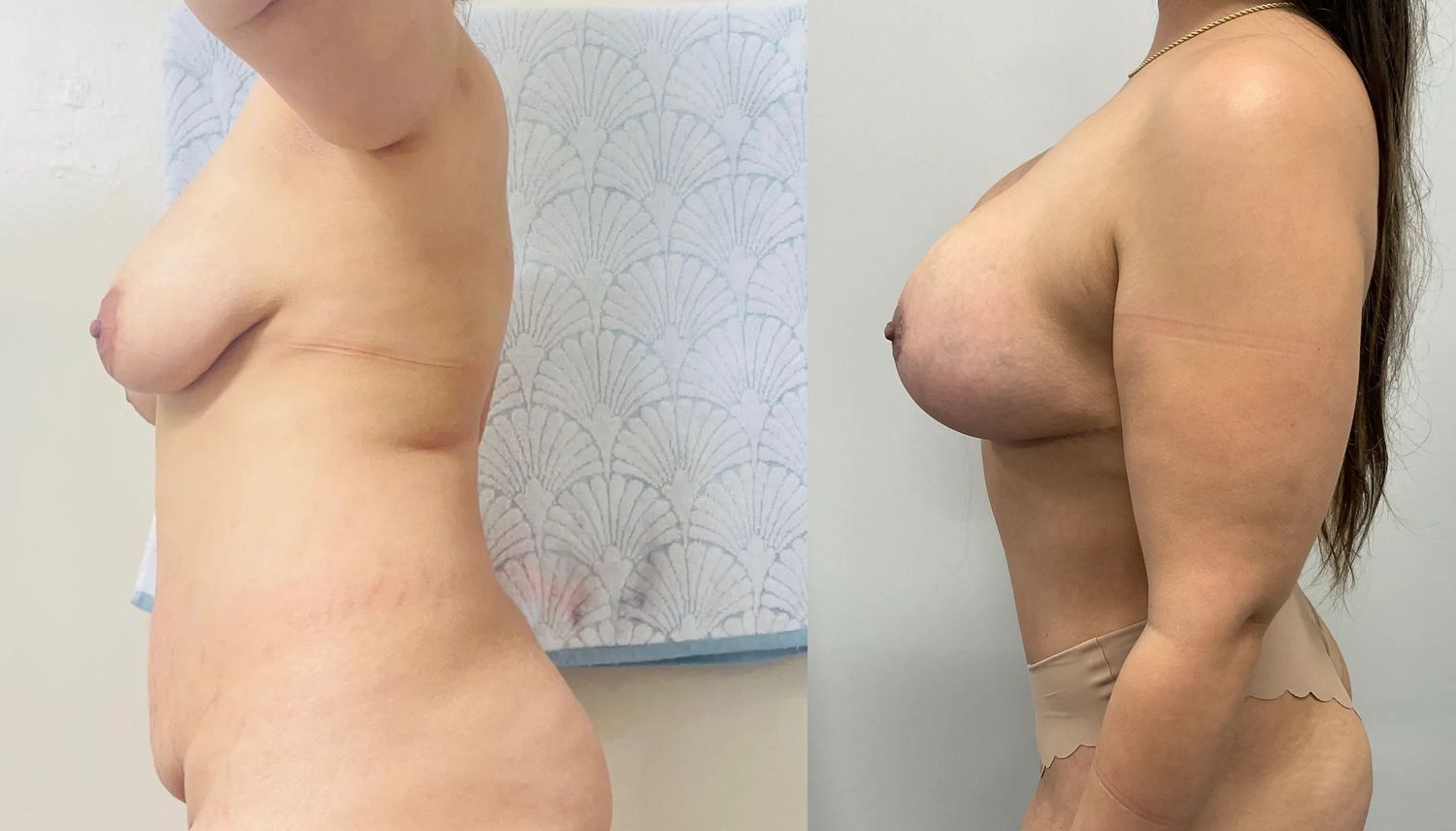 Mommy Makeover Before & After