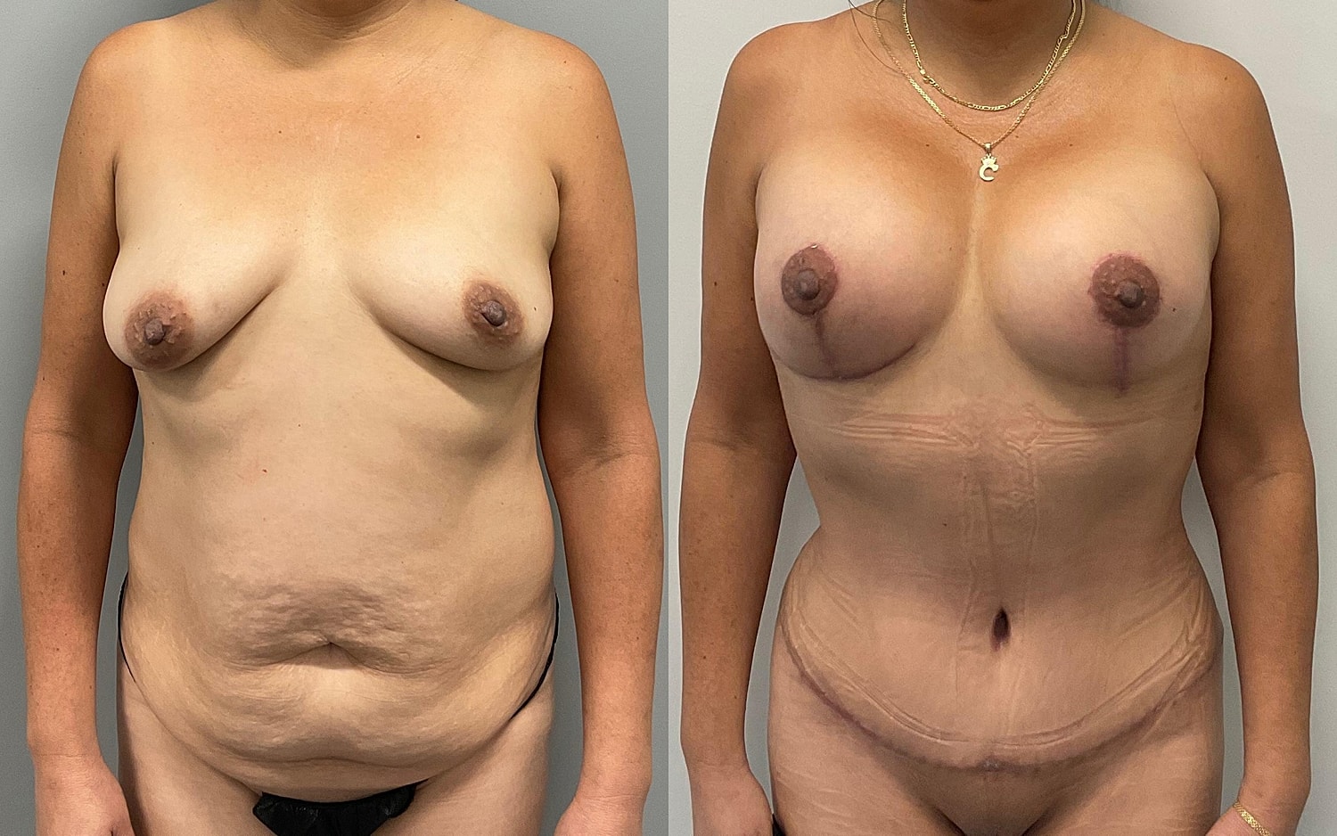 Mommy Makeover Before & After