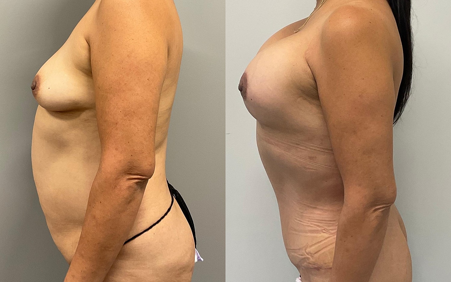 Mommy Makeover Before & After