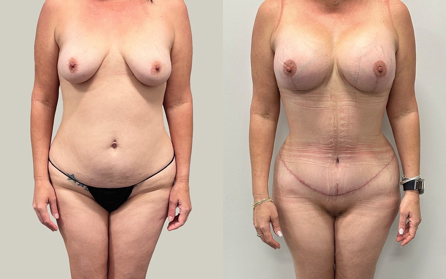 Mommy Makeover Before & After