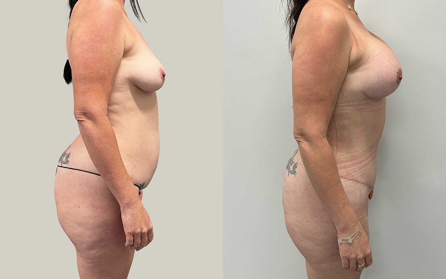 Mommy Makeover Before & After