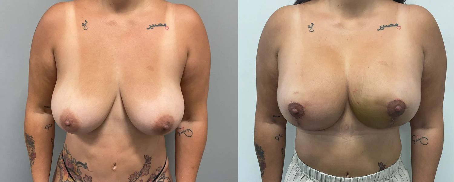 Breast Lift Before & After