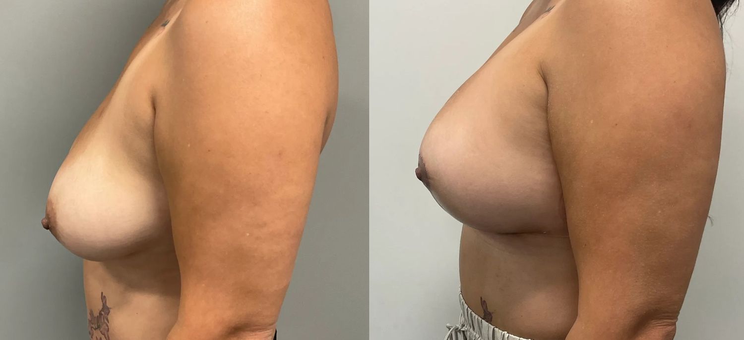 Breast Lift Before & After