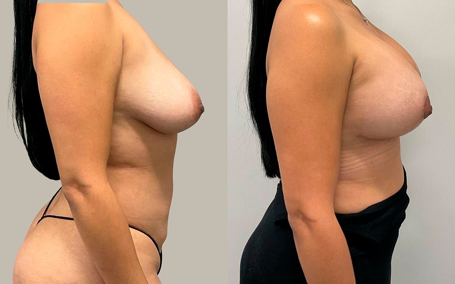 Breast Lift Before & After