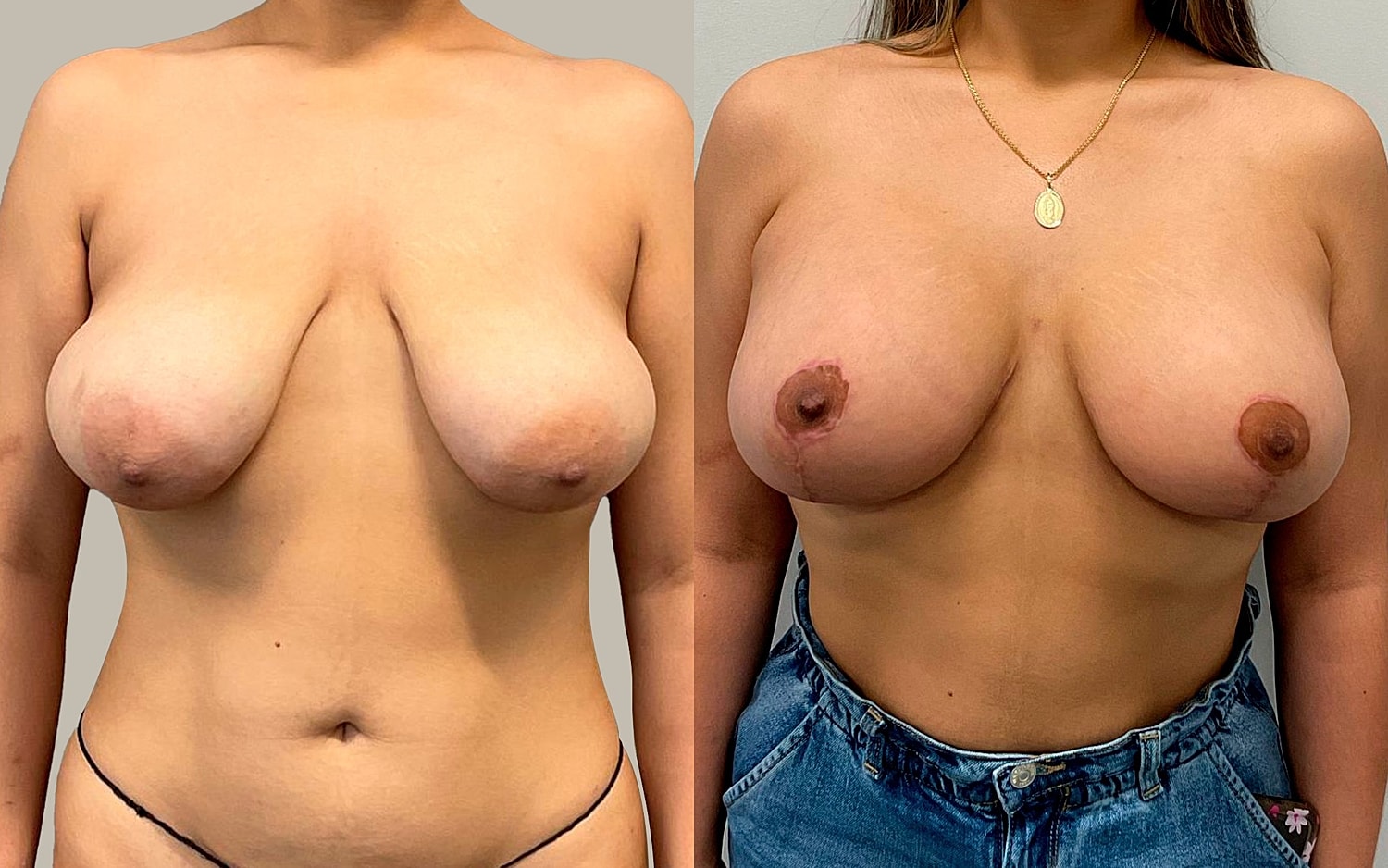 Breast Lift Before & After