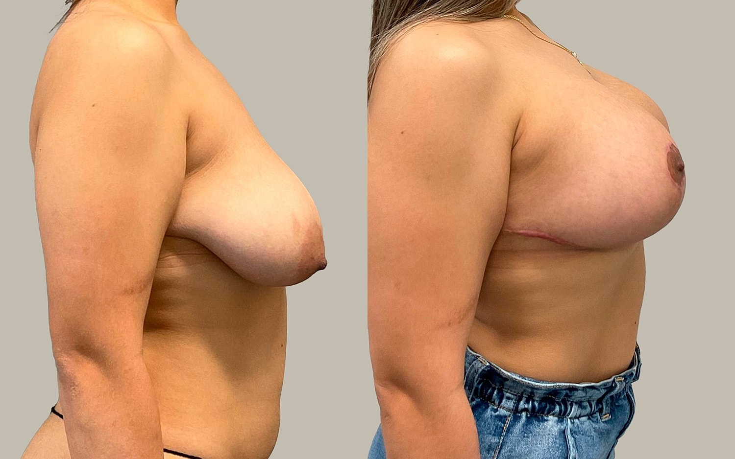 Breast Lift Before & After