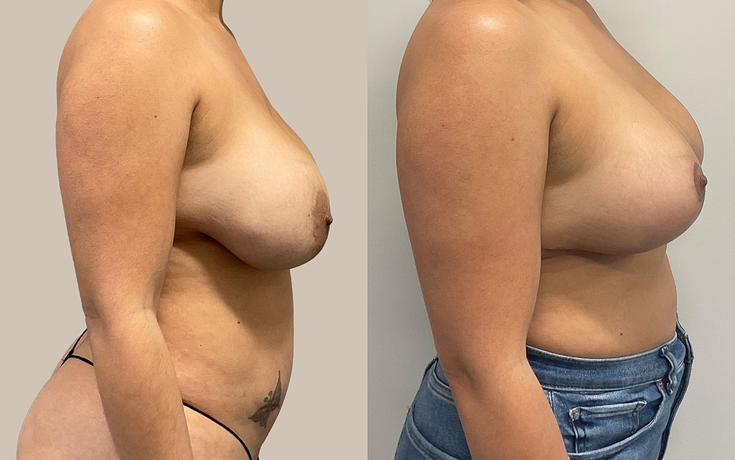 Breast Lift Before & After