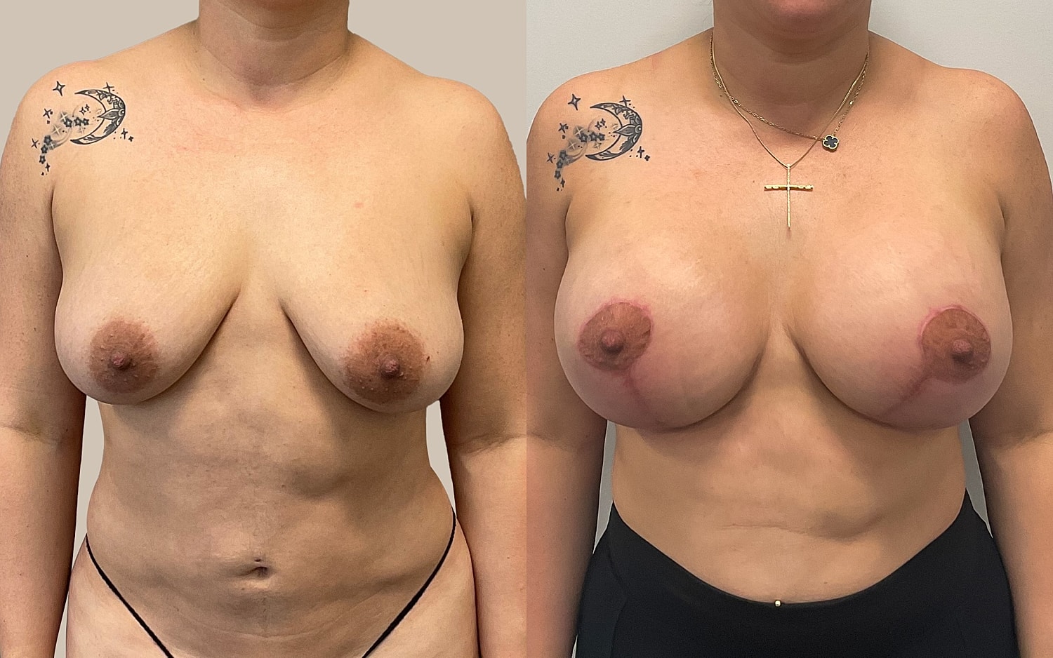Breast Lift Before & After