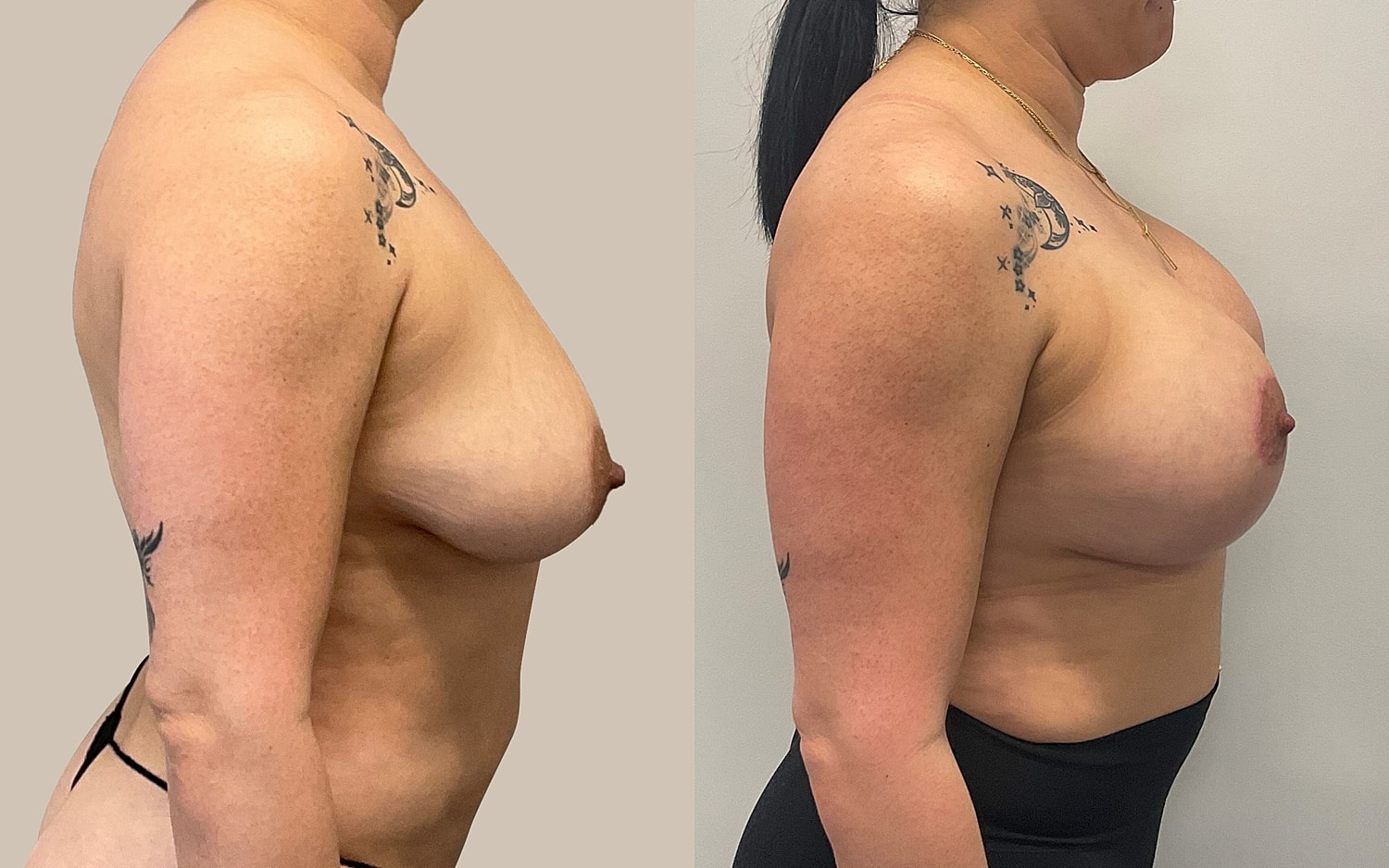 Breast Lift Before & After