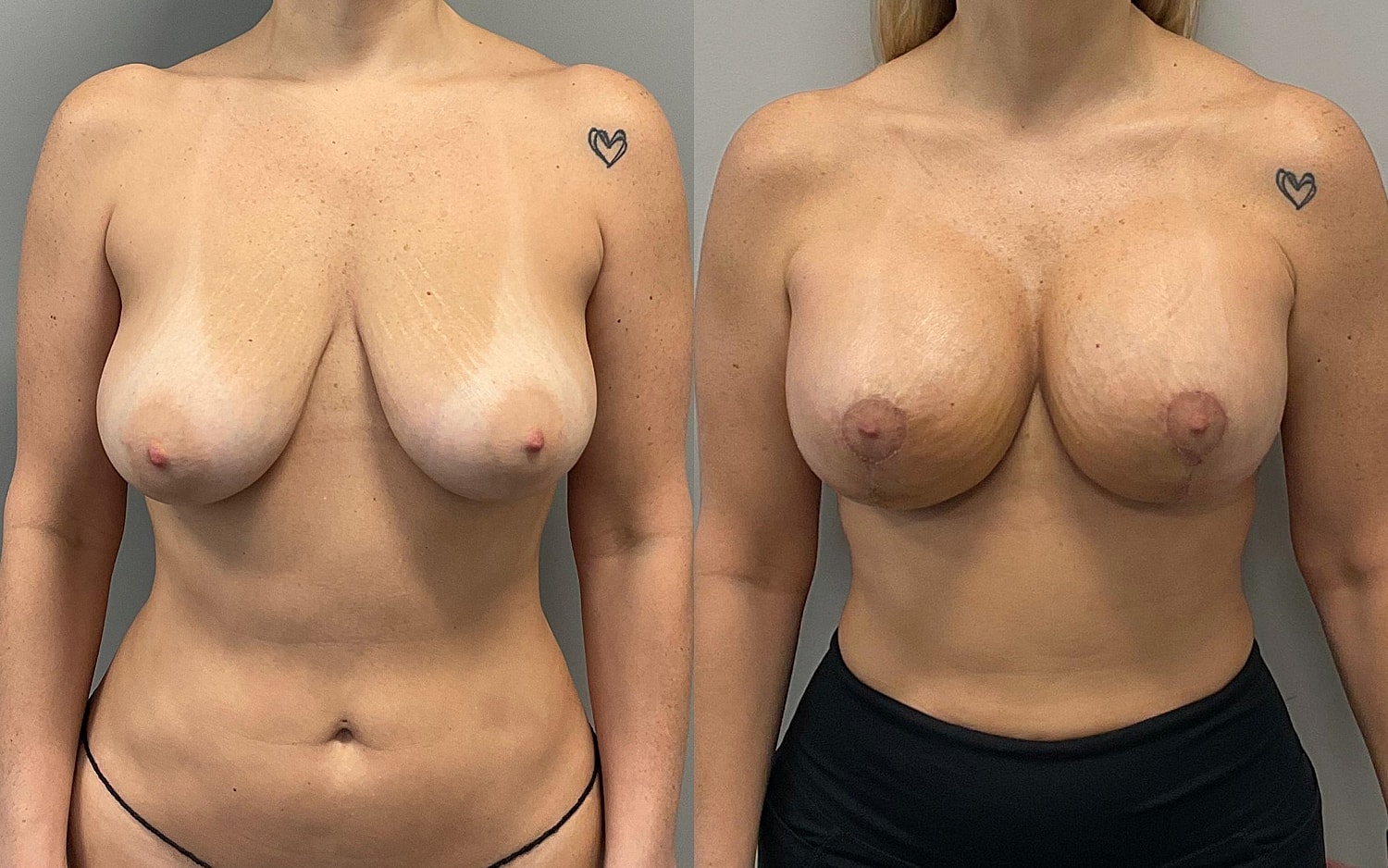 Breast Lift Before & After