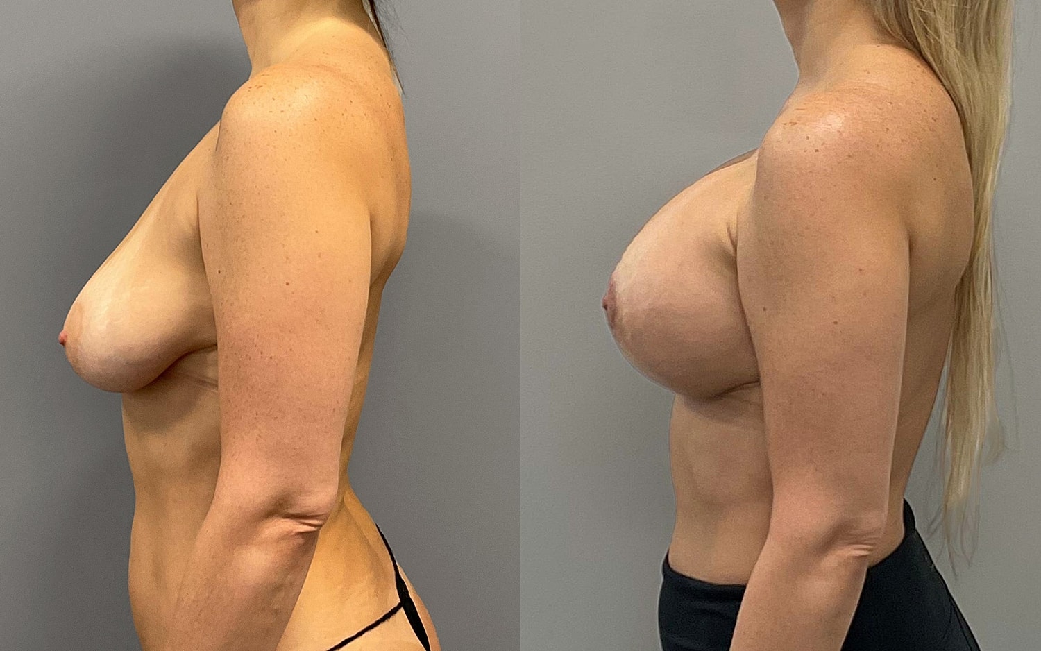 Breast Lift Before & After