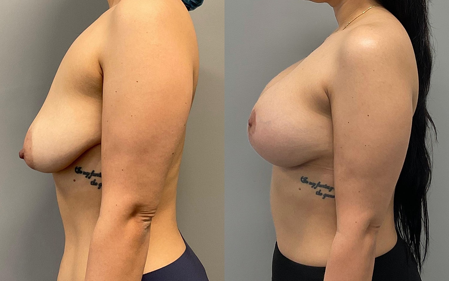 Breast Lift Before & After