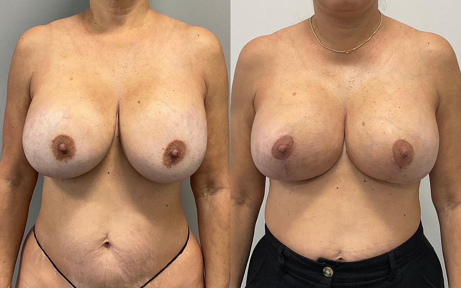 Breast Lift Before & After