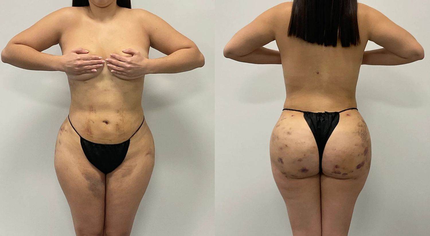 Brazilian Butt Lift Before & After