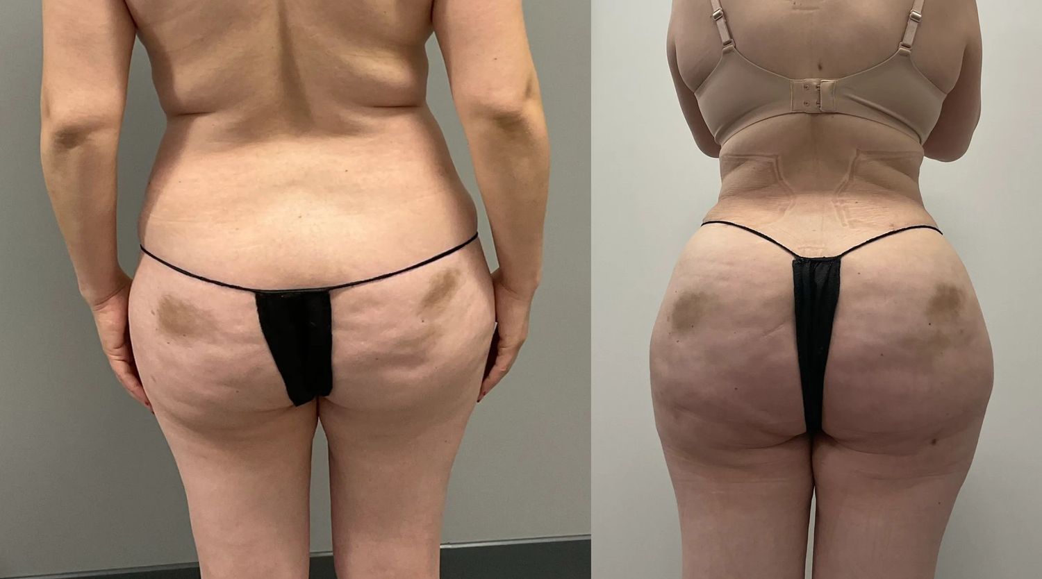 Brazilian Butt Lift Before & After