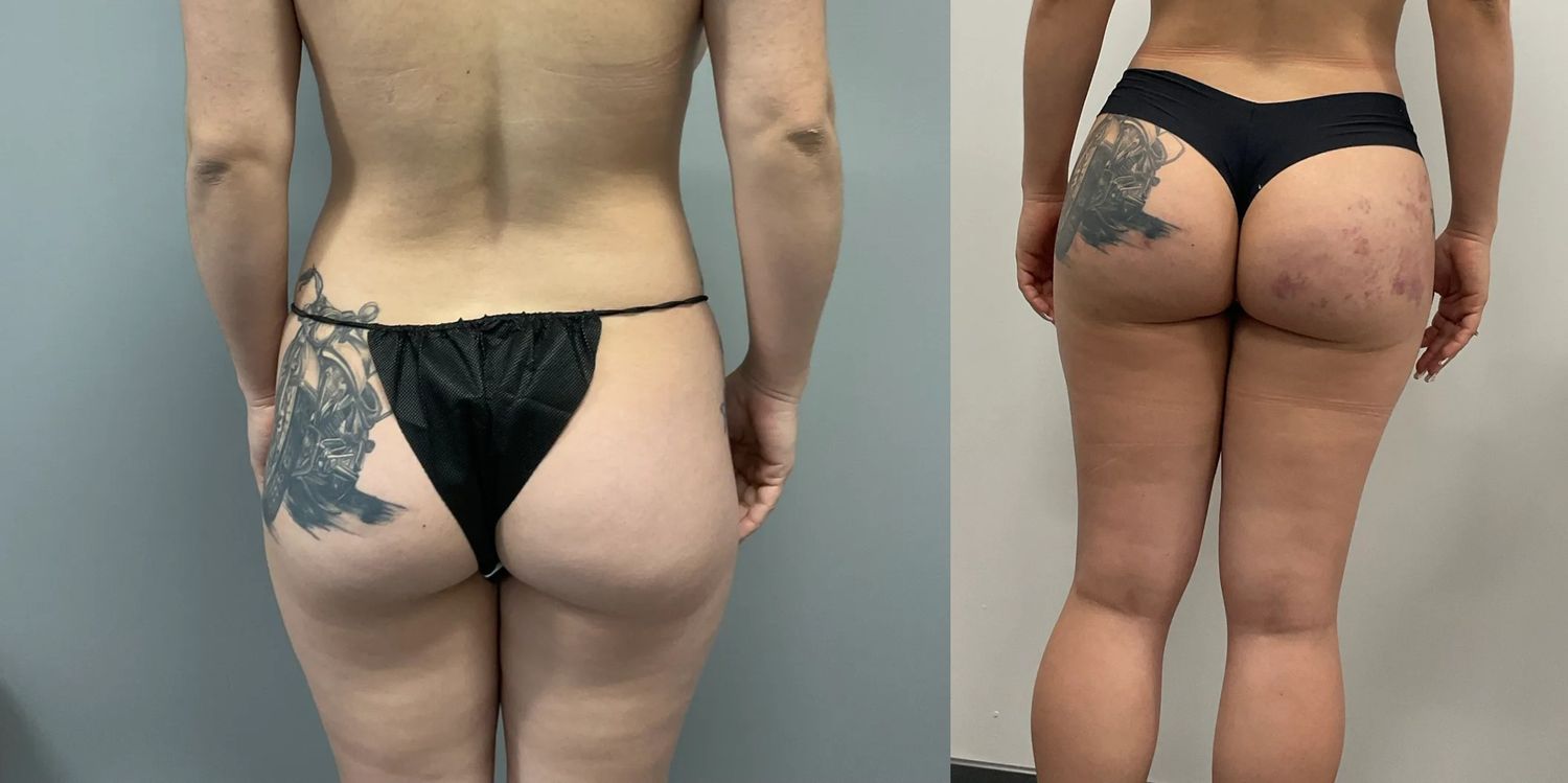 Brazilian Butt Lift Before & After