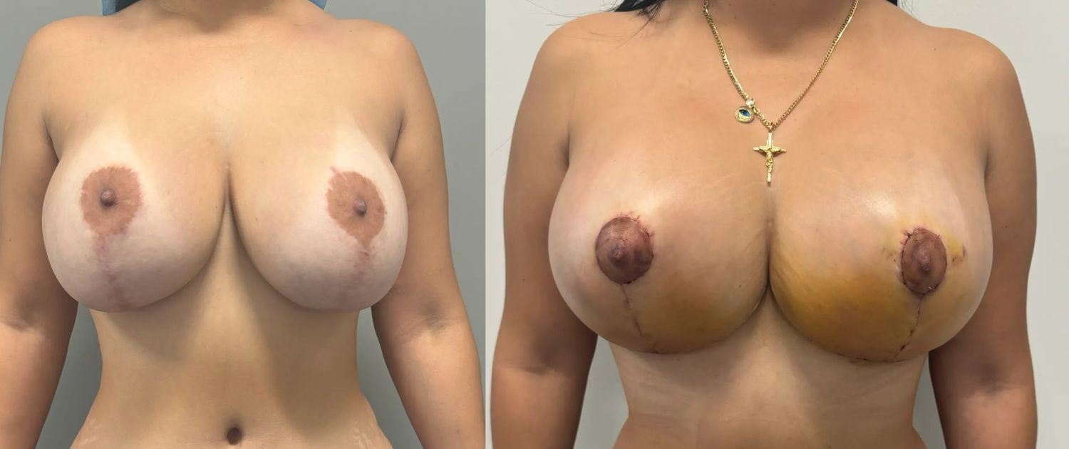 Breast Implant Revision Before & After