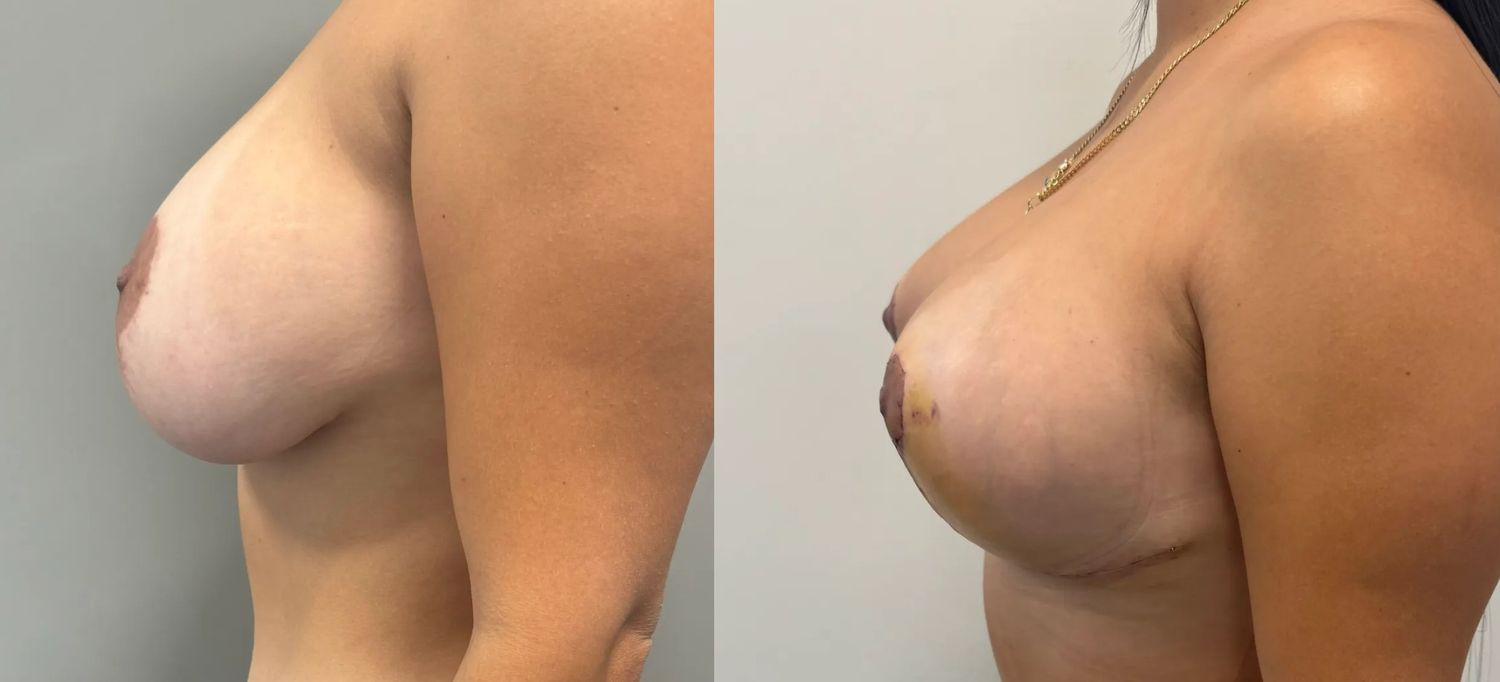 Breast Implant Revision Before & After