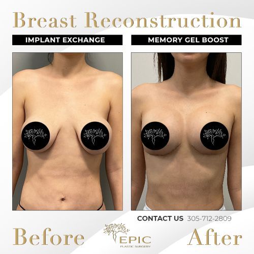 Breast reconstruction: before and after comparison.