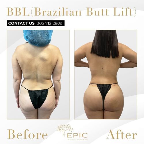 Before and after Brazilian butt lift procedure