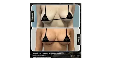 Breast augmentation before and after comparison.