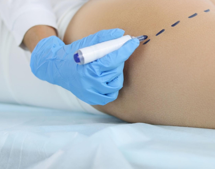 what is ultrasound guided BBL